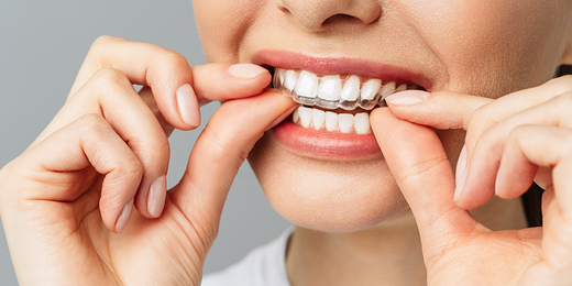 Frau gibt eine durchsichtige Zahnschiene auf ihre Zähne.