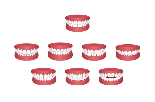 Abbildungen von unterschiedlichen Zahnfehlstellungen